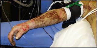 Escharotomy is usually done within the first 2 to 6 hours of a burn injury. Part V Escharotomy Closing The Gap