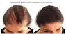 Scalp Camouflage