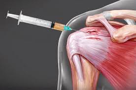 Image result for Biceps Tendon Injection