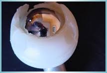 L'arthroplastie de la hanche est un moyen fiable dans le traitement des affections de la hanche. Reprise Des Protheses Totales De Hanche Orthopole 34