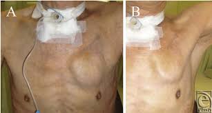 Both icds and pacemakers are medical devices that are implanted inside the bodies of heart patients. The Icd Was Implanted Under The Pmm A Upright Position The Bulging Download Scientific Diagram