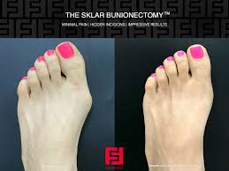 Try these tips for fast recovery and best results after cosmetic surgery. Cosmetic Foot First Podiatry Centers