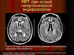 Но что это и почему это развивается? Gipertonicheskaya Encefalopatiya Prezentaciya Onlajn
