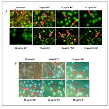 Combined xanthorrhizol-curcumin exhibits synergistic growth inhibitory  activity via apoptosis induction in human breast cancer cells MDA-MB-231
