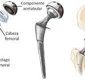 Reemplazo total de cadera (Total Hip Replacement ...