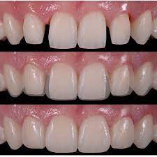 · close gaps between teeth without . Dranuriaoteroficial Restorativedentistry Veneers Dentist Dentistry Estheticdentistry Composites 3m Ivoclair Tokuy Cosmetic Dentistry Dental Veneers Dentistry