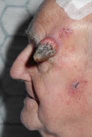 Image result for cornu cutaneum)