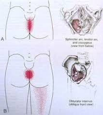 Ortho Therapists This One S For You Pelvic Floor Dysfunction Trigger Points Levator Ani
