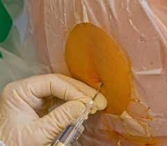 Wie schmerzhaft ist eine geburt ohne pda wirklich? Periduralanasthesie Pda Schmerzfreie Geburt Graviditas Net