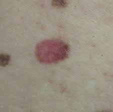 So it&#x27;s important you visit your gp as soon as possible if you notice a change in your skin. Skin Cancer Pictures Includes Moles And Other Skin Spots