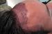 Hairline Top Hair Transplant