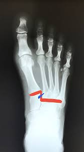 25 overall pick in april, was brought onto the roster to add speed. Tiger S J D Martinez Out With Lisfranc Injury Healthy Feet Podiatry