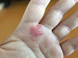 Image result for dermatitis contacta allergica