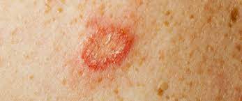 Developed by dermatologists, this website is your online guide. Ø£Ù‡Ù… Ø§Ù„Ù…Ø¹Ù„ÙˆÙ…Ø§Øª Ø¹Ù† ÙØ·Ø±ÙŠØ§Øª Ø§Ù„Ø¬Ù„Ø¯ Ø§Ù„Ø­Ù…Ø±Ø§Ø¡ ÙˆÙŠØ¨ Ø·Ø¨