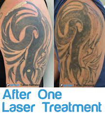 Not everyone comes to skin renew for full tattoo removals.many clients may want a partial tattoo removal, or tattoo lightening so their existing artwork can be covered up with a new design.just like full tattoo removal, there are similar reasons for the tattoo cover up or partial tattoo removal. Premium Tattoo Removal Here S Another Tribal Tattoo We Ve Started To Work On One Treatment Has Already Started The Fading Process Brilliantly Our Patient Couldn T Be Happier With The Result We Take
