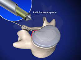 Maybe you would like to learn more about one of these? Disc Protrusion Or Disc Herniation Percutaneous Endoscopic Disc Nucleoplasty Thermo Ray Joint Surgeon Com