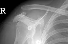 This can be a simple injury through a sprain to the ligaments (grade 1 shoulder joint separation). Acromioclavicular Joint Injury Shoulder Elbow Orthobullets