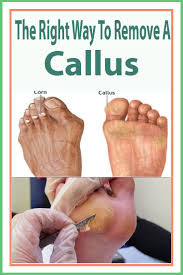 Pin On Corns Calluses