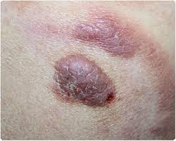 Exposing blood cells to light. What Is Cutaneous T Cell Lymphoma