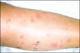 We did not find results for: Cutaneous Sarcoidosis A Dermatologic Masquerader American Family Physician