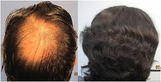  (over 50% of my hair lost due to shock loss) after his three invasive, damaging (to my scalp more. Hair Transplant Los Angeles Cost Cost Of Hair Restoration In Los Angeles
