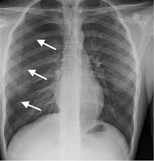 Image result for Open Pneumothorax