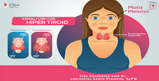 Ini adalah gejala yang paling umum. Mata Melotot Bisa Jadi Karena Masalah Tiroid Rs St Carolus Rumah Sakit Di Jakarta Pusat