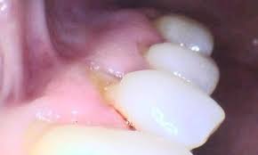 Image result for Tooth Abrasion
