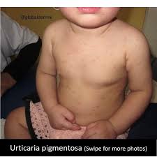 Image result for Urticaria pigmentosa children