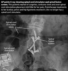 Failed Back Surgery Syndrome Treatment Options Caring Medical Florida