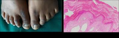 Image result for Pitting nails feet