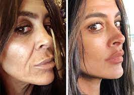 Mini-facelift World Renown Mini-facelift Specialist In New York Natural Face Lift Mini Face Lift Plastic Surgery