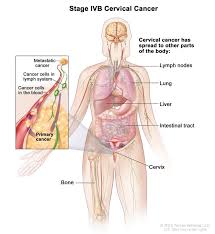How to prevent the spread of plague? Cancerhelp Online Nci Cancer Diagnosis And Treatment
