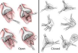 Alibaba.com owns large scale of external hemorrhoids images in high definition, along with many other relevant product images hemorrhoids external,treatment for external hemorrhoids,treatment of external hemorrhoids. How To Get Rid Of Hemorrhoids Types Causes And Treatments