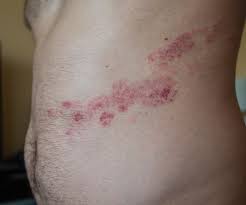 Learn about who is at risk and what can be done to help prevent shingles. Herpes Zoster Infection The Bmj