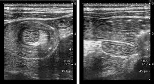 Maybe you would like to learn more about one of these? Intussusception In Adults Institutional Review Sciencedirect
