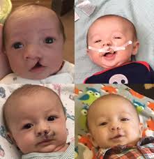 The birth of a newborn should be a time of celebration for every family.  However, the arrival of a child with a cleft condition often comes with  shock. This was the case