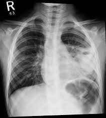 Image result for Lung Abscess