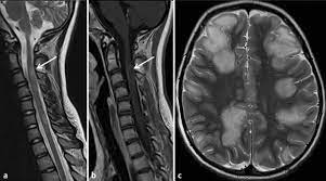 Causes include multiple sclerosis, neuromyelitis optica. Https Www Thieme Connect Com Products Ejournals Pdf 10 1055 S 0042 112446 Pdf