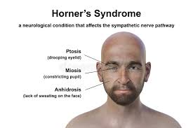 Image result for Anhidrosis