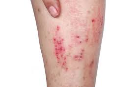 Image result for Atopic Dermatitis