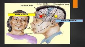Al afectar a la descodificación de los fonemas, la afasia de wernicke se caracteriza por la incapacidad para comprender un mensaje o repetirlo. Afasia De Broca Y Wernicke