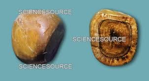 Image result for Gallstone