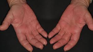Handdermatitis Ubersicht Altmeyers Enzyklopadie Fachbereich Allergologie