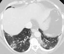 Assalamualaikum, legen min er azza, jeg vil spørre, jeg er menstruerende, jeg har allerede dokket i 2 dager, men hvorfor er magen fortsatt syk og jeg har magesmerter. Covid 19 Med Akutte Magesmerter Som Debutsymptom Tidsskrift For Den Norske Legeforening