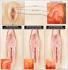 Image result for Phimosis