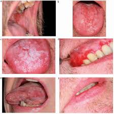 Image result for lichen planus on tongue)