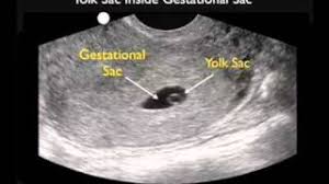 If you are in any doubt about having any type of scan, you should consult your gp. Ultrasound Pelvic Wikem