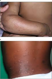 Image result for skin rash acute hiv infection