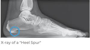 Given above are some of the reasons that could cause bone spurs on top of foot and the remedies for the same. Praxis Leonardo Arzte Fur Orthopadie Und Traumatologie